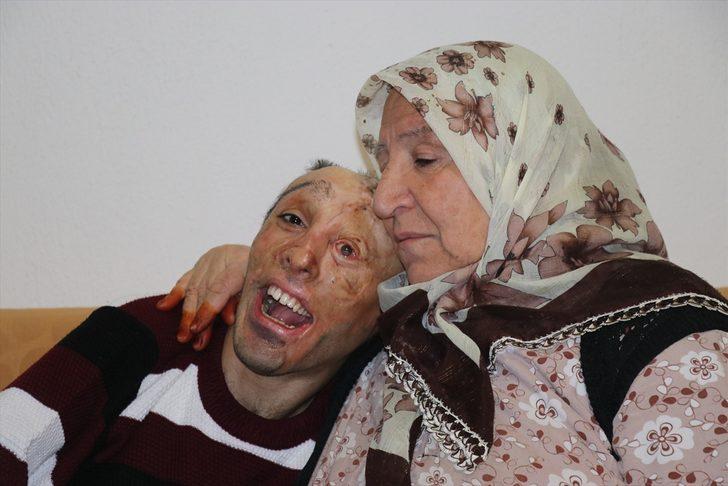 Vücudu çocukken yanan gence Sağlık Bakanlığından tedavi desteği G5