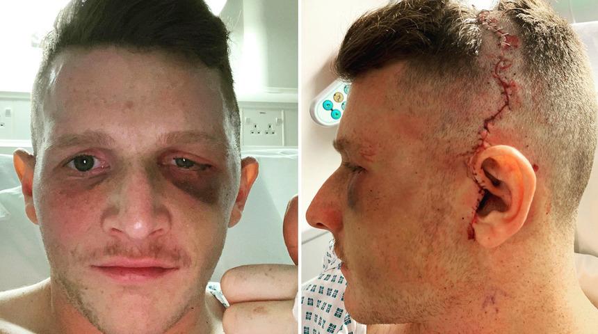 Yıldız sporcu sol gözünü kaybetti