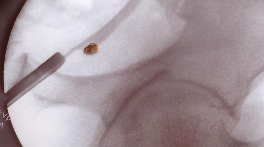 B&ouml;brek taşı hastalığı son yıllarda yaygınlaşıyor! Korunmanın 7 yolu