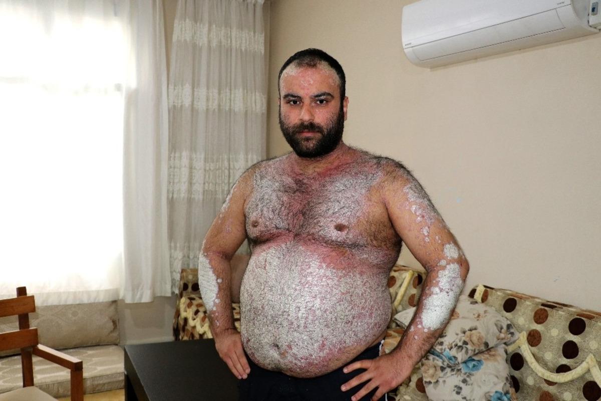 İki yılda t&uuml;m v&uuml;cudunu kapladı! Kimse korkmasın diye dışarı &ccedil;ıkmıyor