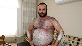 İki yılda tüm vücudunu kapladı! Kimse korkmasın diye dışarı çıkmıyor