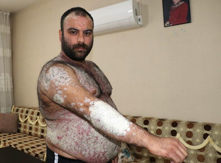 İki yılda tüm vücudunu kapladı! Kimse korkmasın diye dışarı çıkmıyor G2