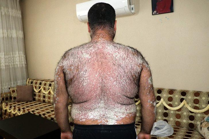 İki yılda tüm vücudunu kapladı! Kimse korkmasın diye dışarı çıkmıyor G5