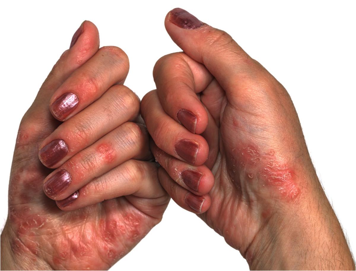 Evde egzama tedavisi nasıl yapılır? İşte izlemeniz gereken doğal yollar