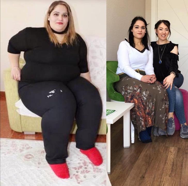 3 yaşında fil hastalığına yakalanan Diyarbakırlı Gamze, 15 ayda 163 kilo verdi G3