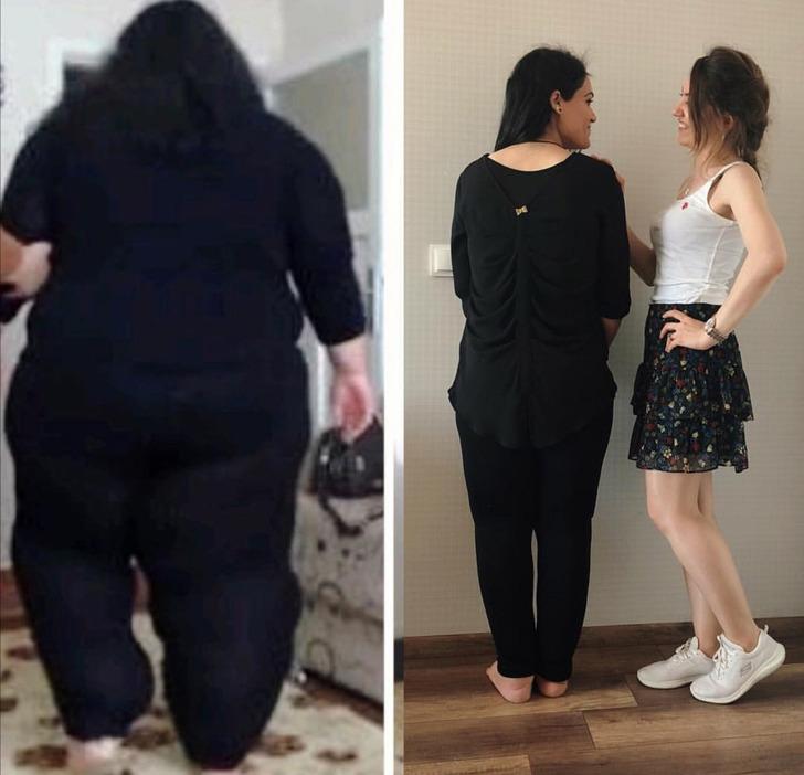 3 yaşında fil hastalığına yakalanan Diyarbakırlı Gamze, 15 ayda 163 kilo verdi G4