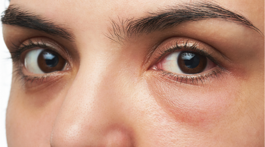 Göz altı torbaları yüz ifadesini etkiliyor