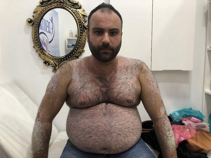 Tüm vücudunu sedef saran hasta derdine Ankara’da çare arıyor G1