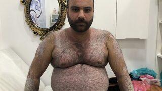 Tüm vücudunu sedef saran hasta derdine Ankara’da çare arıyor