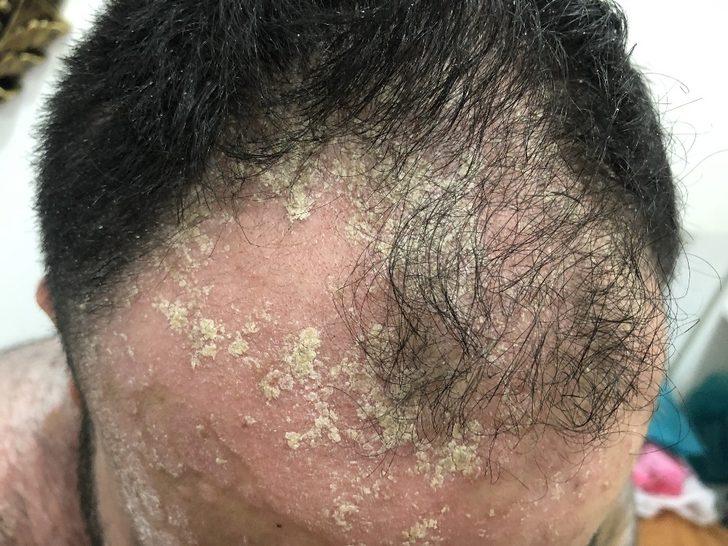 Tüm vücudunu sedef saran hasta derdine Ankara’da çare arıyor G2