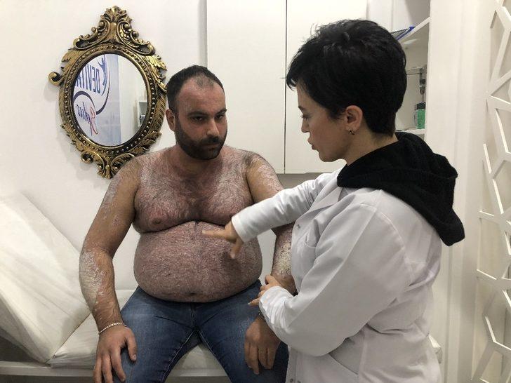 Tüm vücudunu sedef saran hasta derdine Ankara’da çare arıyor G3