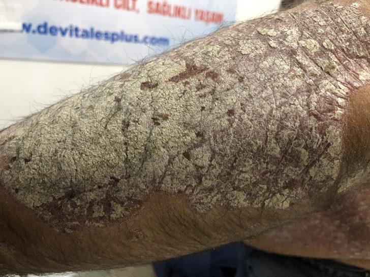 Tüm vücudunu sedef saran hasta derdine Ankara’da çare arıyor G4