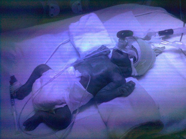 900 gram doğdu, yaşam savaşını kazandı, şimdi 5 yaşında G2