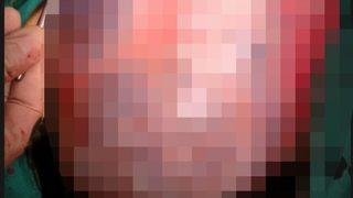 Genç kadının karnındaki 30 santimetrelik kist operasyonla alındı