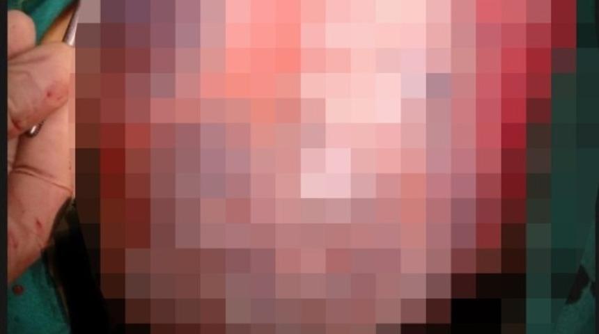 Genç kadının karnındaki 30 santimetrelik kist operasyonla alındı