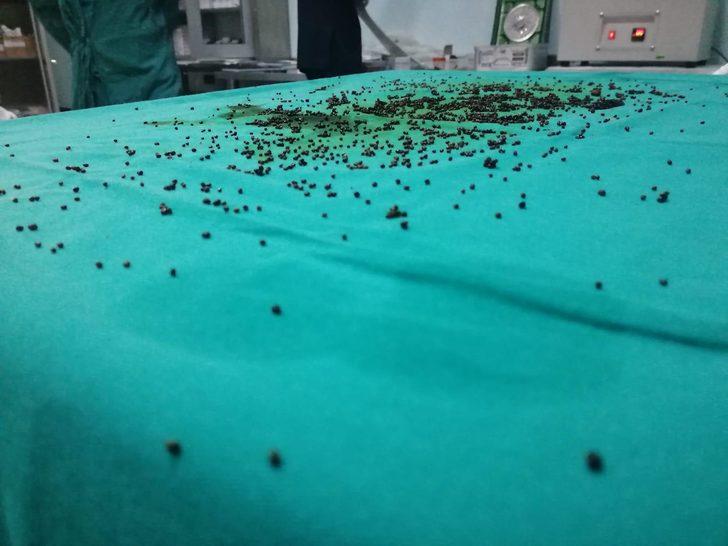 Safra kesesinden 3 bin 765 taş çıktı G1