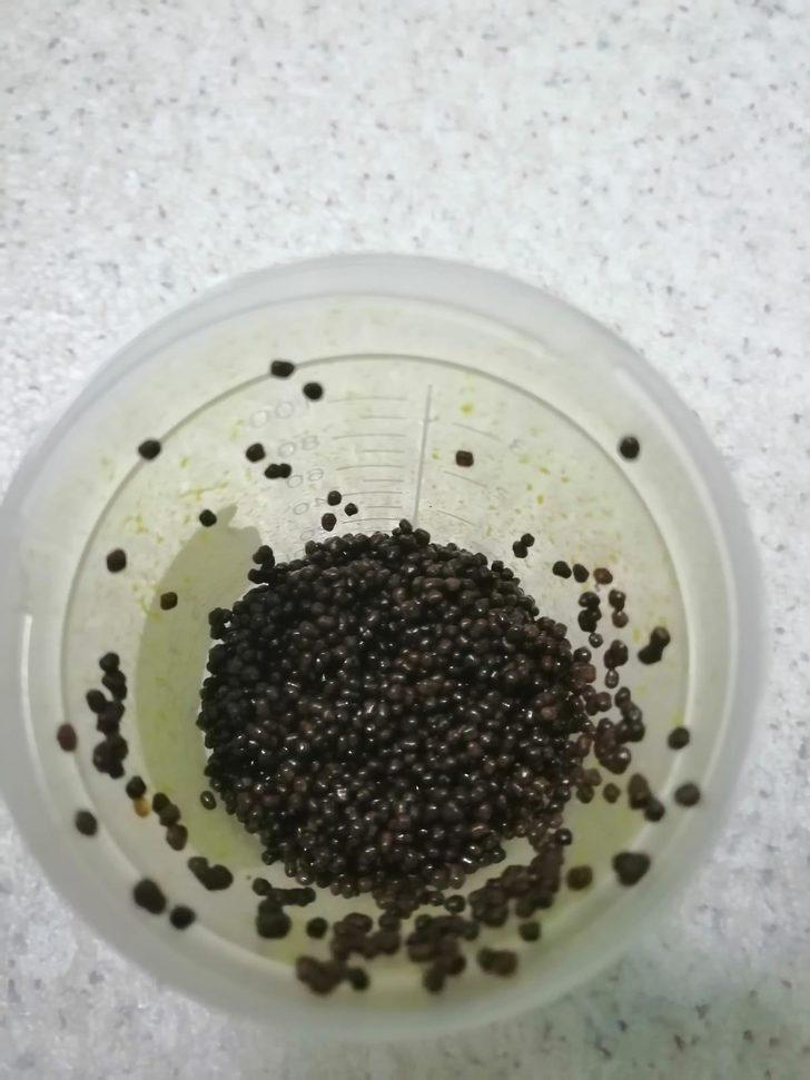 Safra kesesinden 3 bin 765 taş çıktı G3