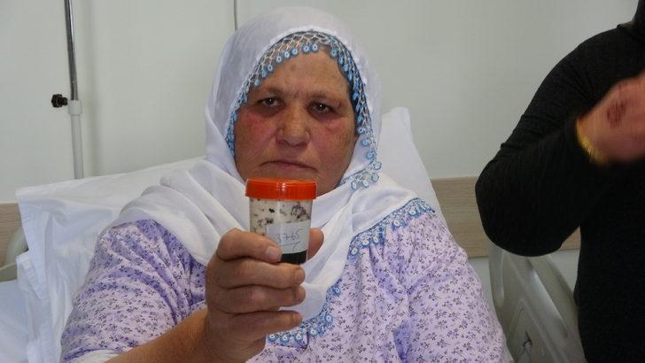 Safra kesesinden 3 bin 765 taş çıktı G4