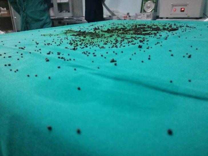 Safra kesesinden çıkan taşlar şoke etti! 4 personel 1 saatte sayabildi G4