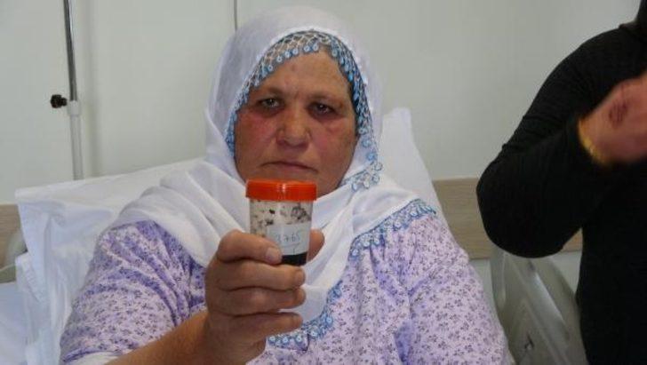 Safra kesesinden çıkan taşlar şoke etti! 4 personel 1 saatte sayabildi G2