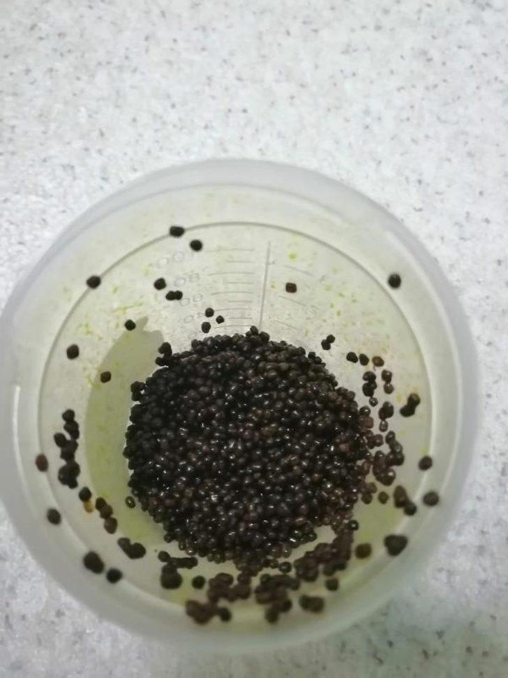 Safra kesesinden çıkan taşlar şoke etti! 4 personel 1 saatte sayabildi G3