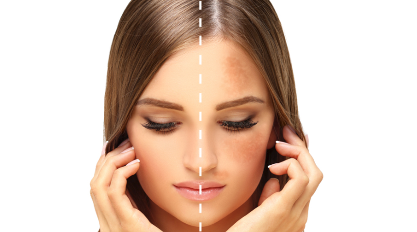 Ciltte oluşan lekelerin sebepleri ve tedavi yöntemleri