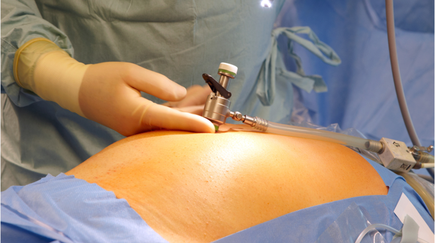 Kadın hastalıklarında laparoskopik yöntemler yüz güldürüyor