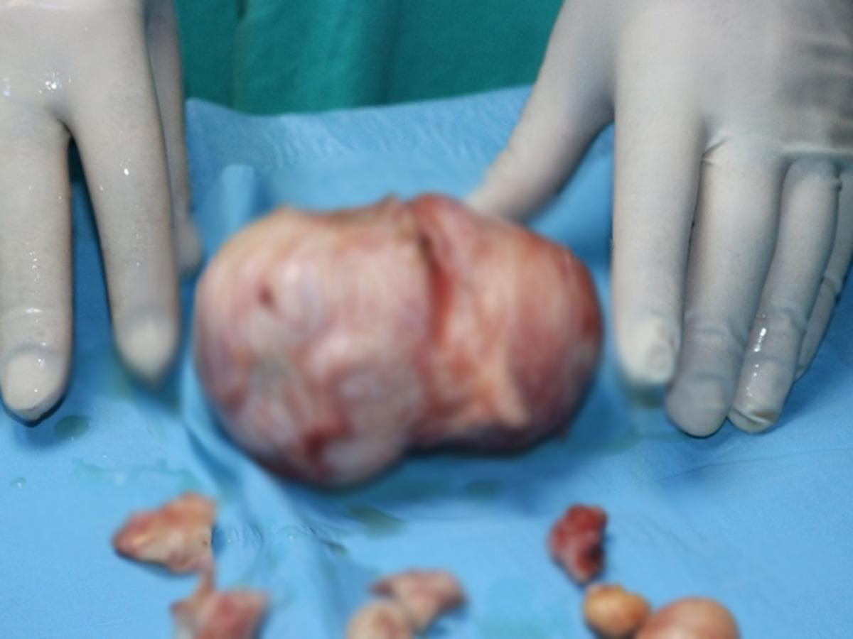 Diyarbakır'da gen&ccedil; kızın karnından dev miyom &ccedil;ıkarıldı