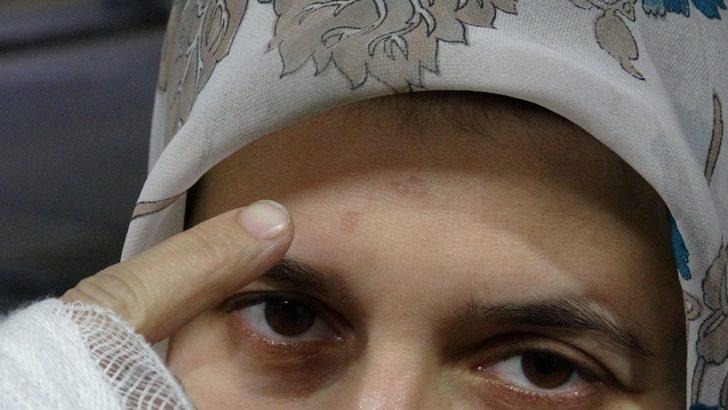 Eşini gelinlikle karşılamıştı! Eline ve alnına sigara bastı G5