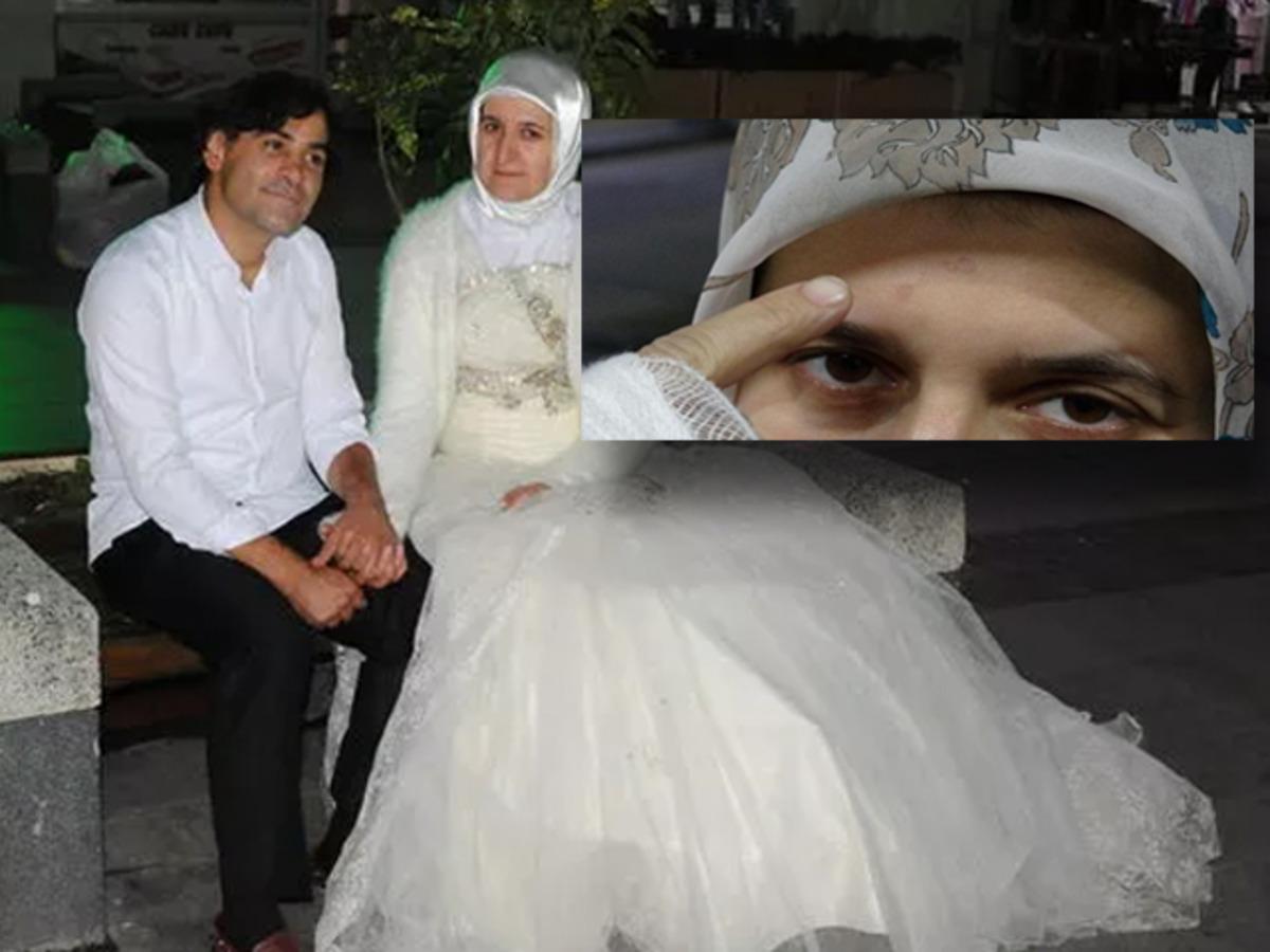 Eşini gelinlikle karşılamıştı! Eline ve alnına sigara bastı