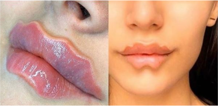 Yeni güzellik trendi şeytan dudaklarına karşı uzmanlar uyarıyor G1