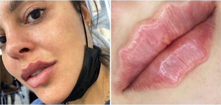 Yeni güzellik trendi şeytan dudaklarına karşı uzmanlar uyarıyor G2