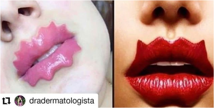 Yeni güzellik trendi şeytan dudaklarına karşı uzmanlar uyarıyor G5