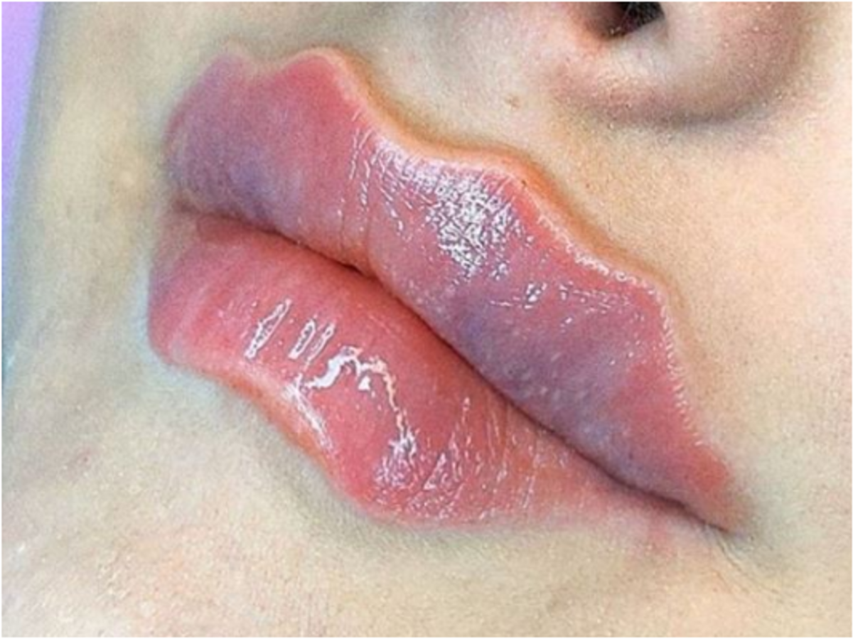 Yeni g&uuml;zellik trendi şeytan dudaklarına karşı uzmanlar uyarıyor