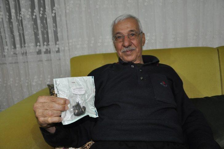 Görenler inanamadı! Kaya parçası değil böbrek taşı G3