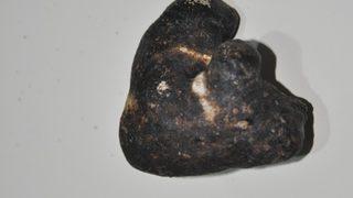 Görenler inanamadı! Kaya parçası değil böbrek taşı