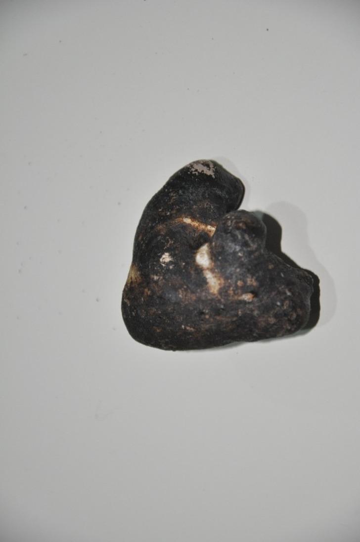 Görenler inanamadı! Kaya parçası değil böbrek taşı G4