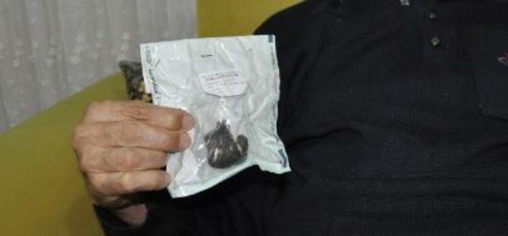 Görenler inanamadı! Kaya parçası değil böbrek taşı G1