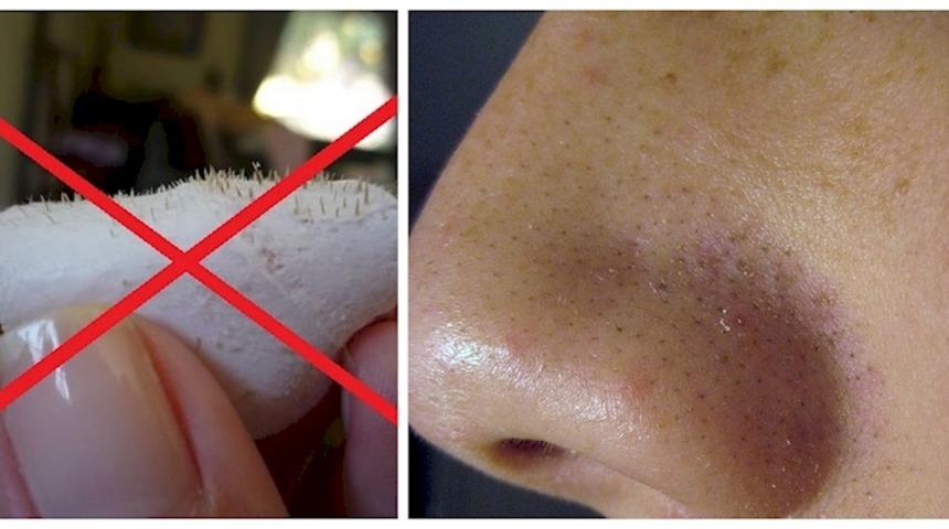 Burun bantlarına elveda deyin! Siyah noktalardan kurtulmanın doğal ve ucuz yolu