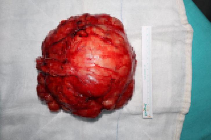 12 yaşındaki kızın memesinde tespit edilen yarım kiloluk tümör temizlendi G2