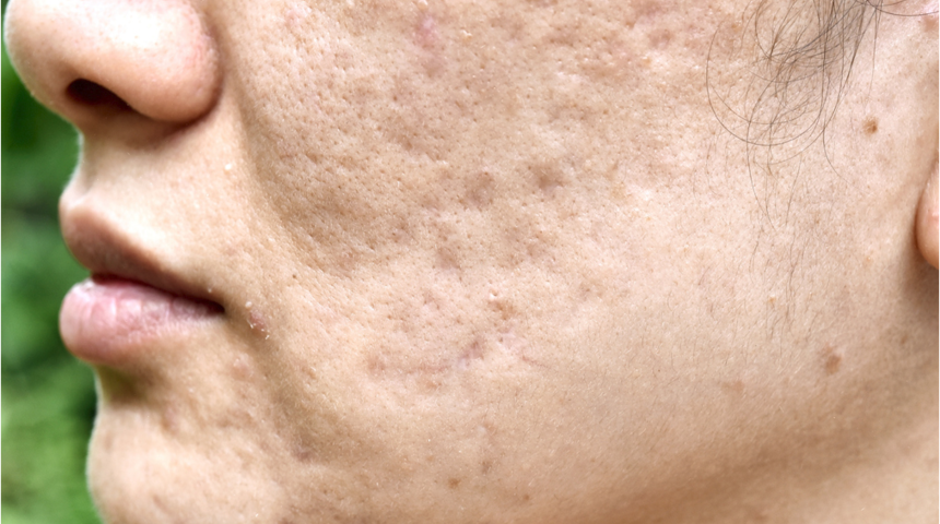 Beslenme şekli de, kozmetik ürünler de akneye neden oluyor! İşte önlemenin 6 etkili yolu