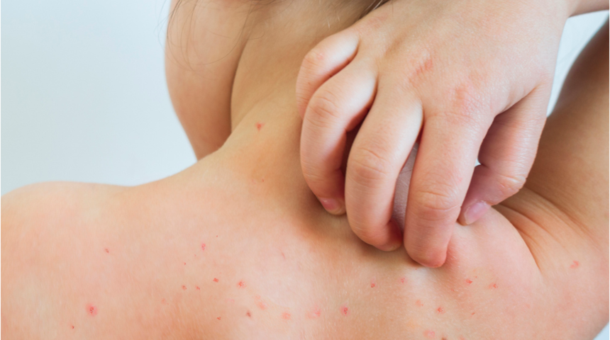 Çocuklarda görülen döküntülerini ciddiye alın