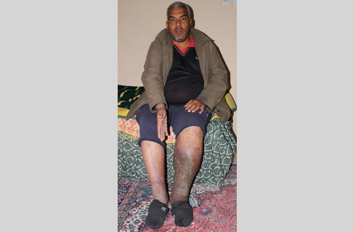 Varis ameliyatı oldu, fil hastası çıktı... 'Hayatım mahvoldu' G1