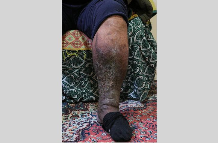 Varis ameliyatı oldu, fil hastası çıktı... 'Hayatım mahvoldu' G2