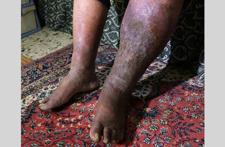 Varis ameliyatı oldu, fil hastası çıktı... 'Hayatım mahvoldu' G3