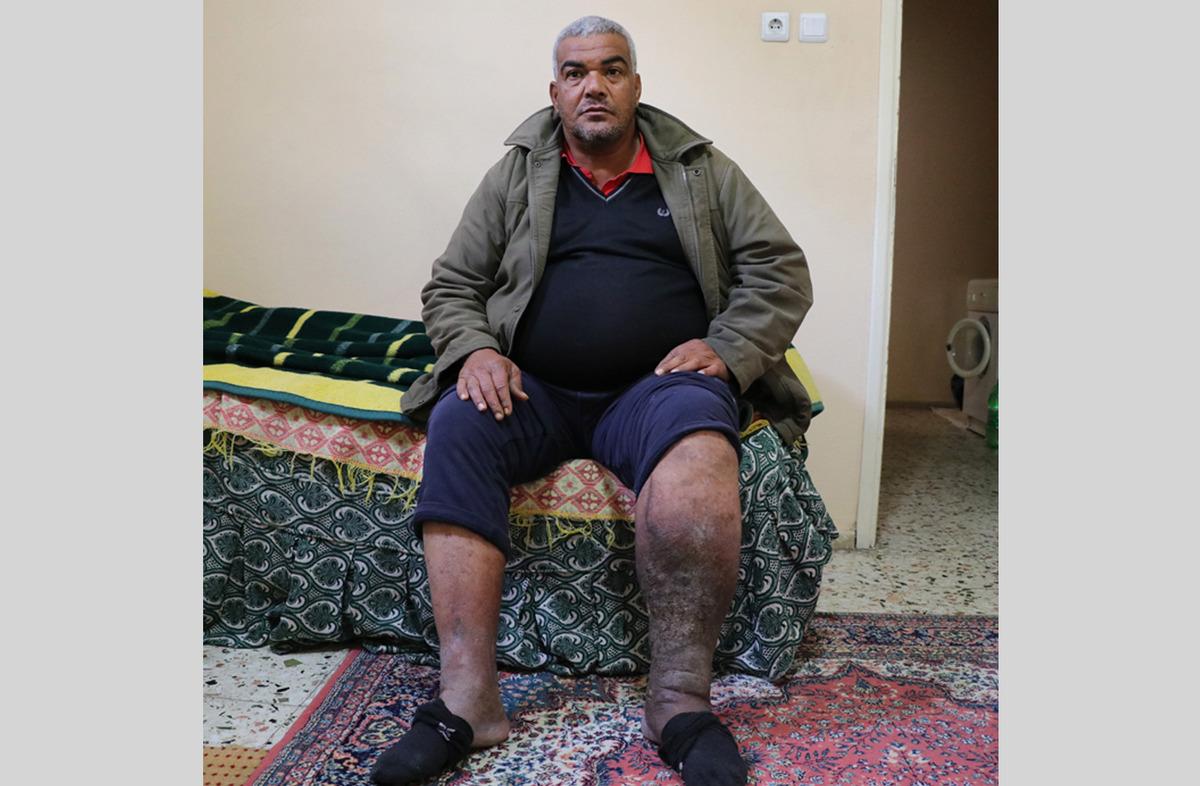 Varis ameliyatı oldu, fil hastası &ccedil;ıktı... 'Hayatım mahvoldu'