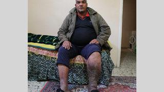 Varis ameliyatı oldu, fil hastası çıktı... 'Hayatım mahvoldu'