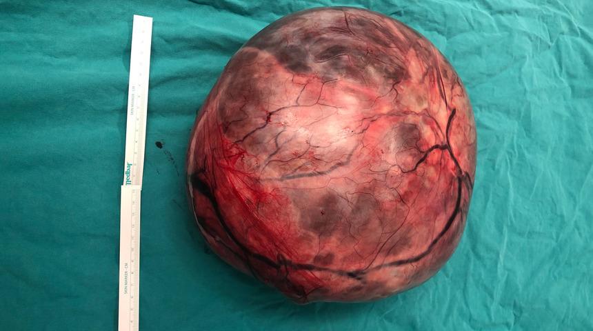 Karın şişkinliğinin sebebi yumurtalığındaki kitle çıktı!