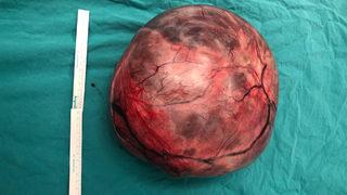 Karın şişkinliğinin sebebi yumurtalığındaki kitle çıktı!