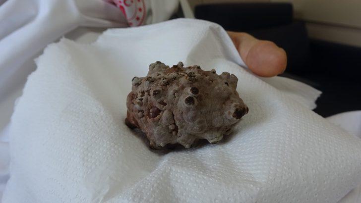 Mesanesinden 130 gramlık taş çıkarıldı; Kendimi hafiflemiş hissediyorum G3